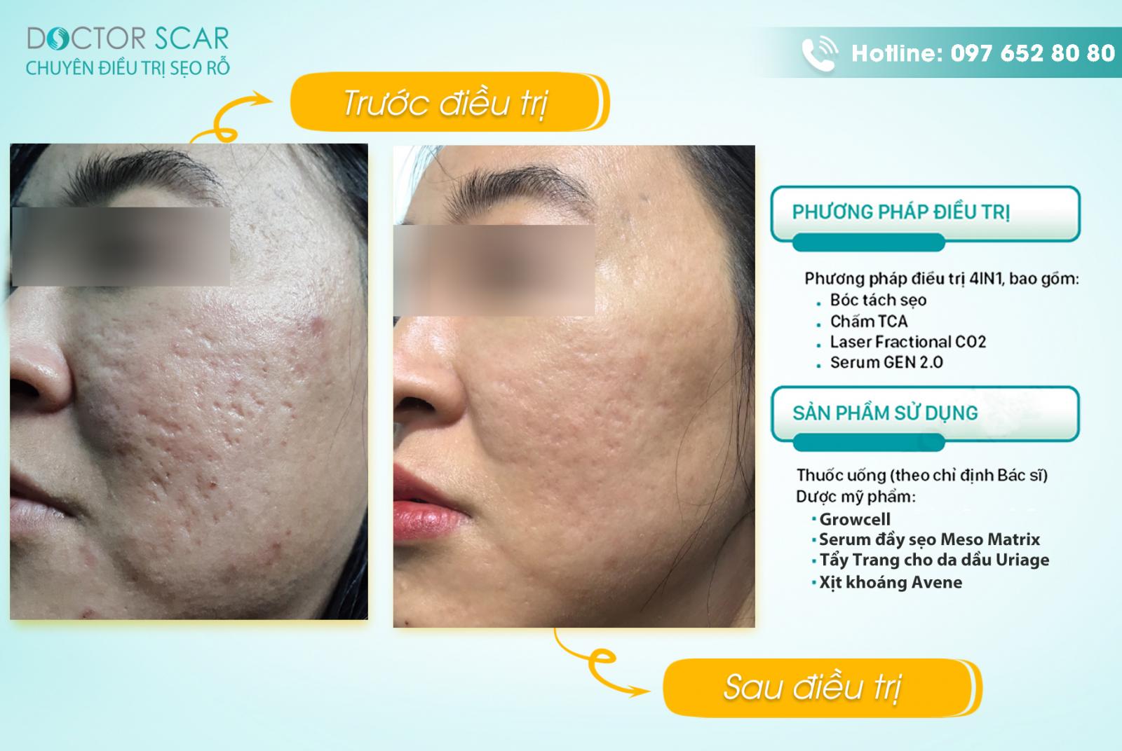 anh-khach-hang-truoc-va-sau-dieu-tri-seo-ro-bang-phuong-phap-4in1 Hình ảnh trước và sau điều trị sẹo rỗ lâu năm
