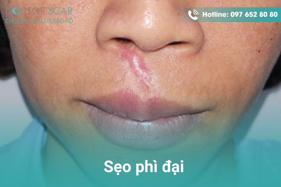 cach-tri-seo-lau-nam-hieu-qua Cách trị sẹo phì đại.