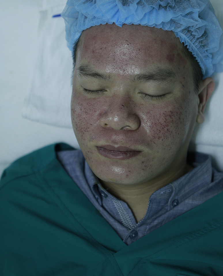 cach-xu-ly-tinh-trang-da-do-rat-sau-khi-tri-seo-0 cach-xu-ly-tinh-trang-da-do-rat-sau-khi-tri-seo-0