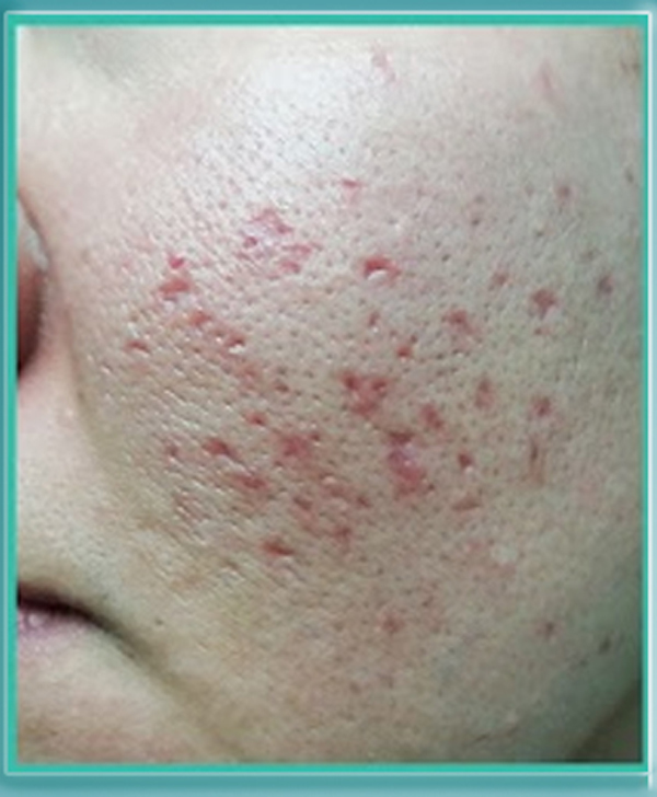 cach-xu-ly-tinh-trang-da-do-rat-sau-khi-tri-seo-3 cach-xu-ly-tinh-trang-da-do-rat-sau-khi-tri-seo-3