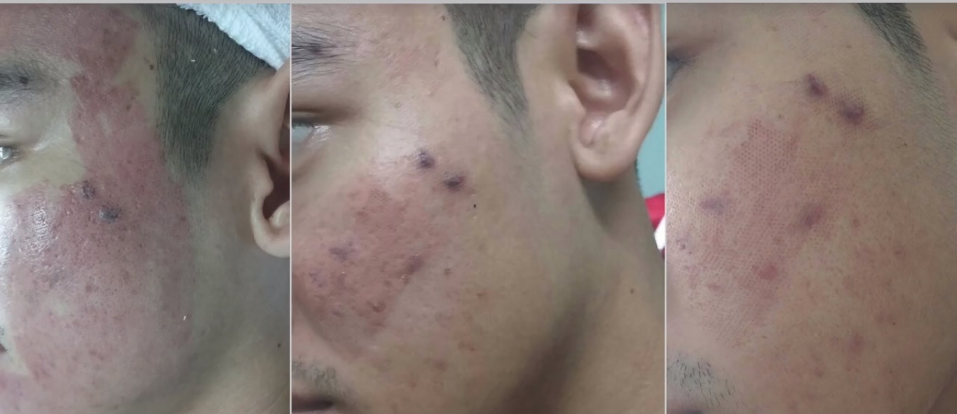 cach-xu-ly-tinh-trang-da-lau-bong-mai-1 cach-xu-ly-tinh-trang-da-lau-bong-mai-1