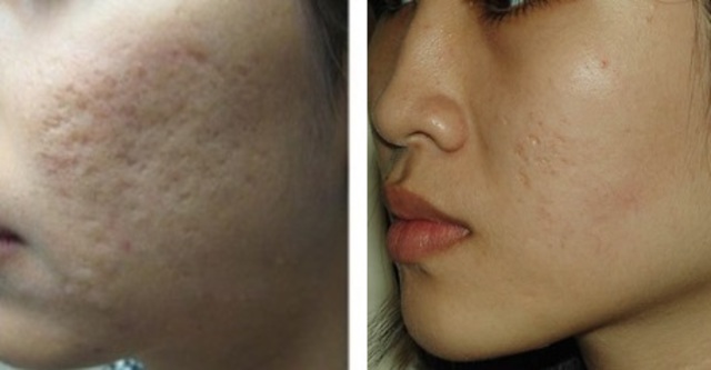 cach_tri_seo_ro_nhanh_chong_hieu_qua_nhat_2014 tri-seo-ro-hieu-qua-nhat