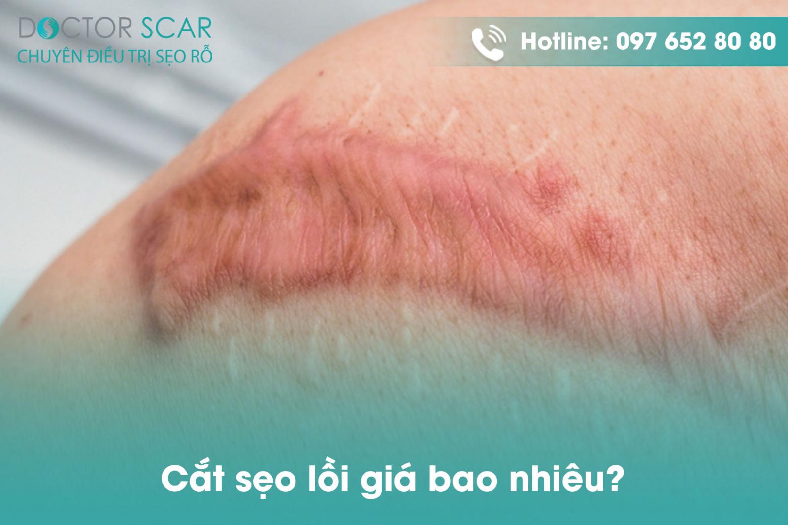 cat-seo-loi-gia-bao-nhieu Cắt sẹo lồi giá bao nhiêu?