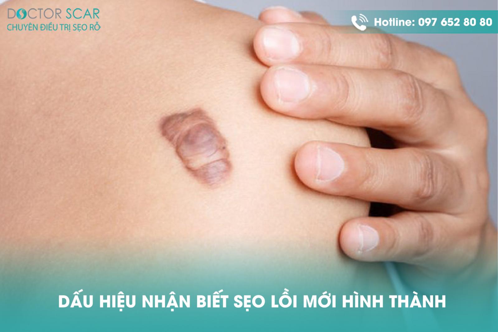 dau-hieu-nhan-biet-seo-loi-moi-hinh-thanh Dấu hiệu nhận biết sẹo lồi mới hình thành