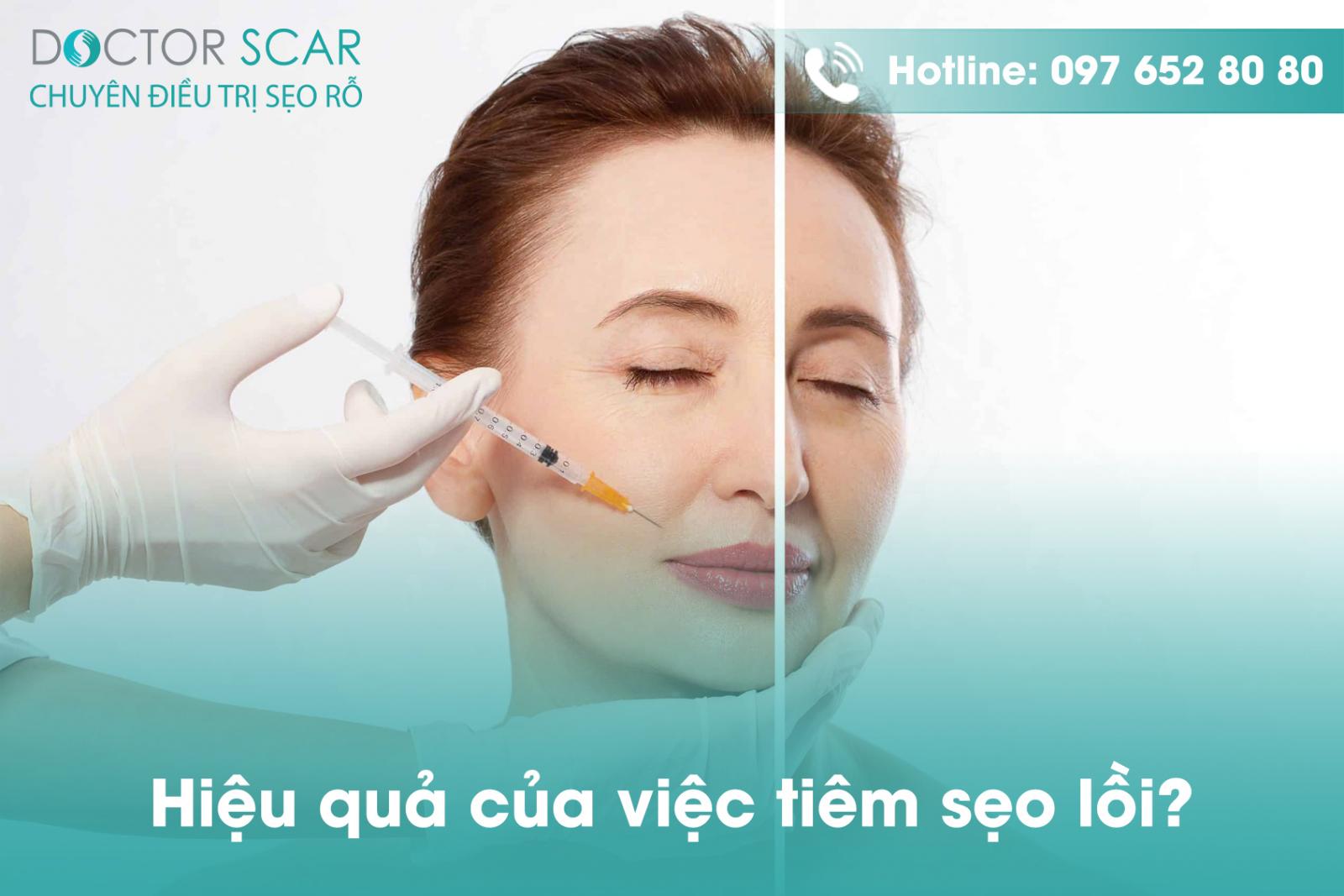 hieu-qua-cua-viec-tiem-seo-loi Hiệu quả của việc tiêm sẹo lồi?