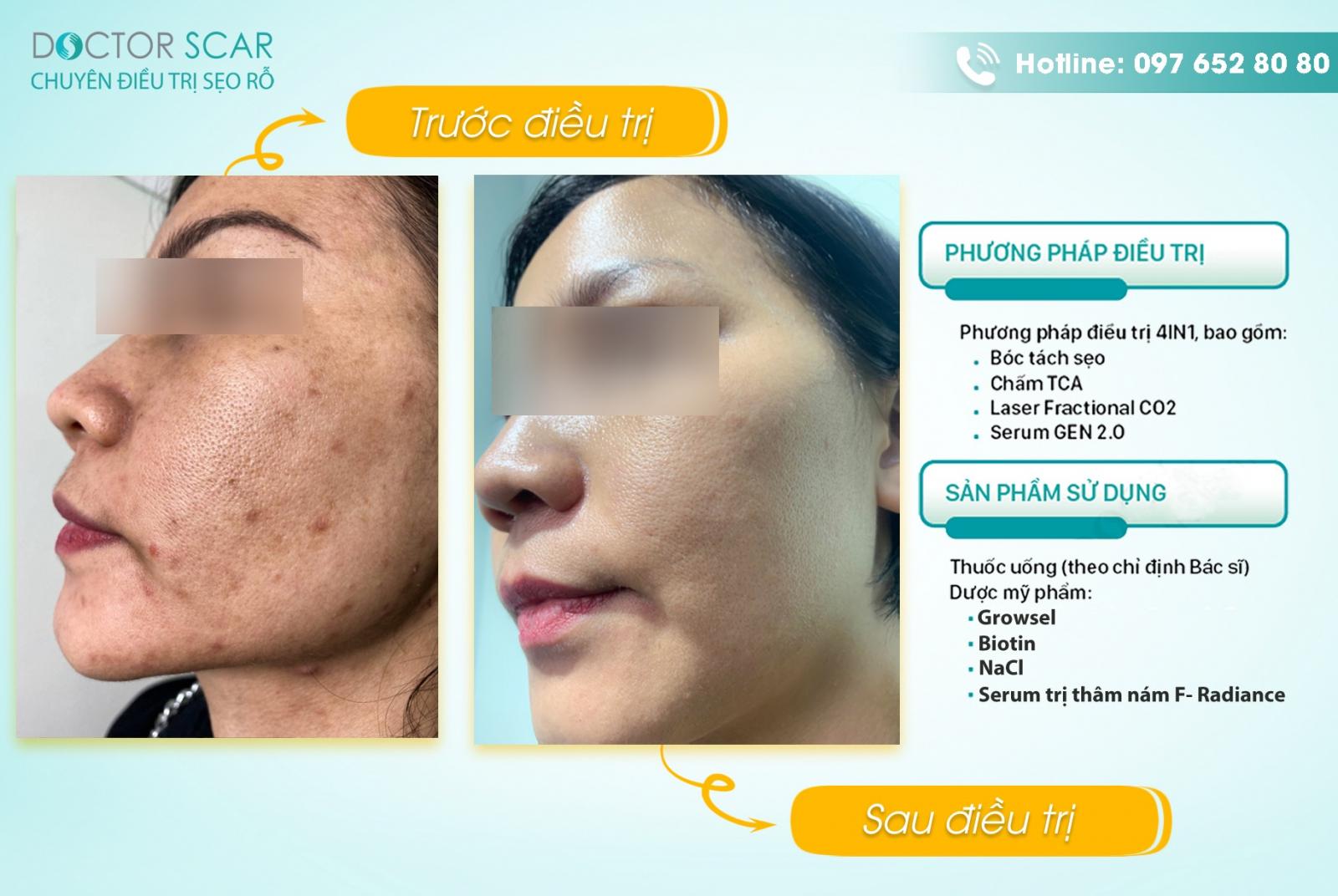 hinh-anh-khach-hang-sau-dieu-tri-seo-tham-bang-laser-co2 Hình ảnh khách hàng sau điều trị sẹo thâm bằng Laser CO2