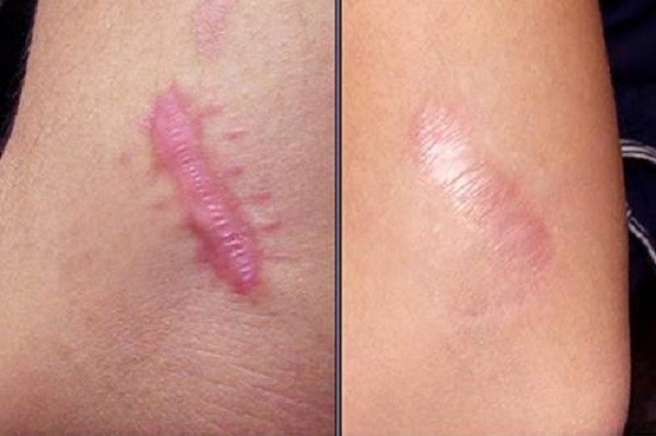 image43 chi phí trị sẹo lồi