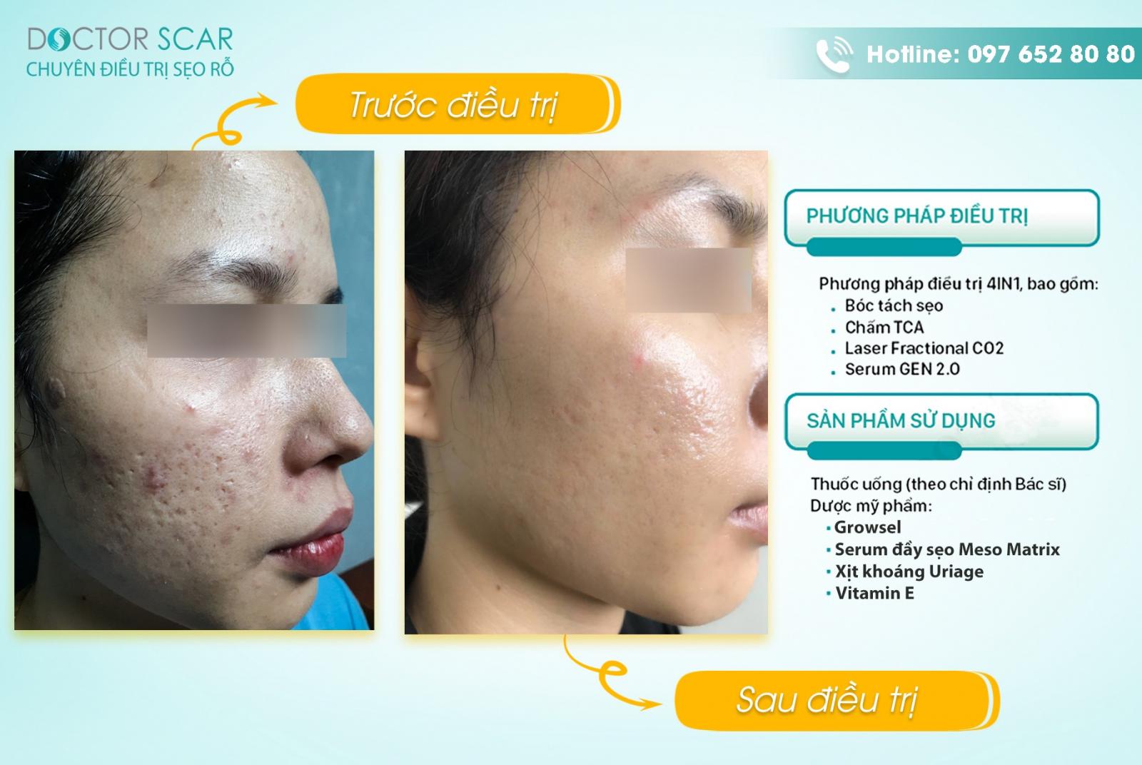 khach-hang-sau-dieu-tri-seo-tham-bang-laser-co2 Khách hàng sau điều trị sẹo thâm bằng Laser CO2
