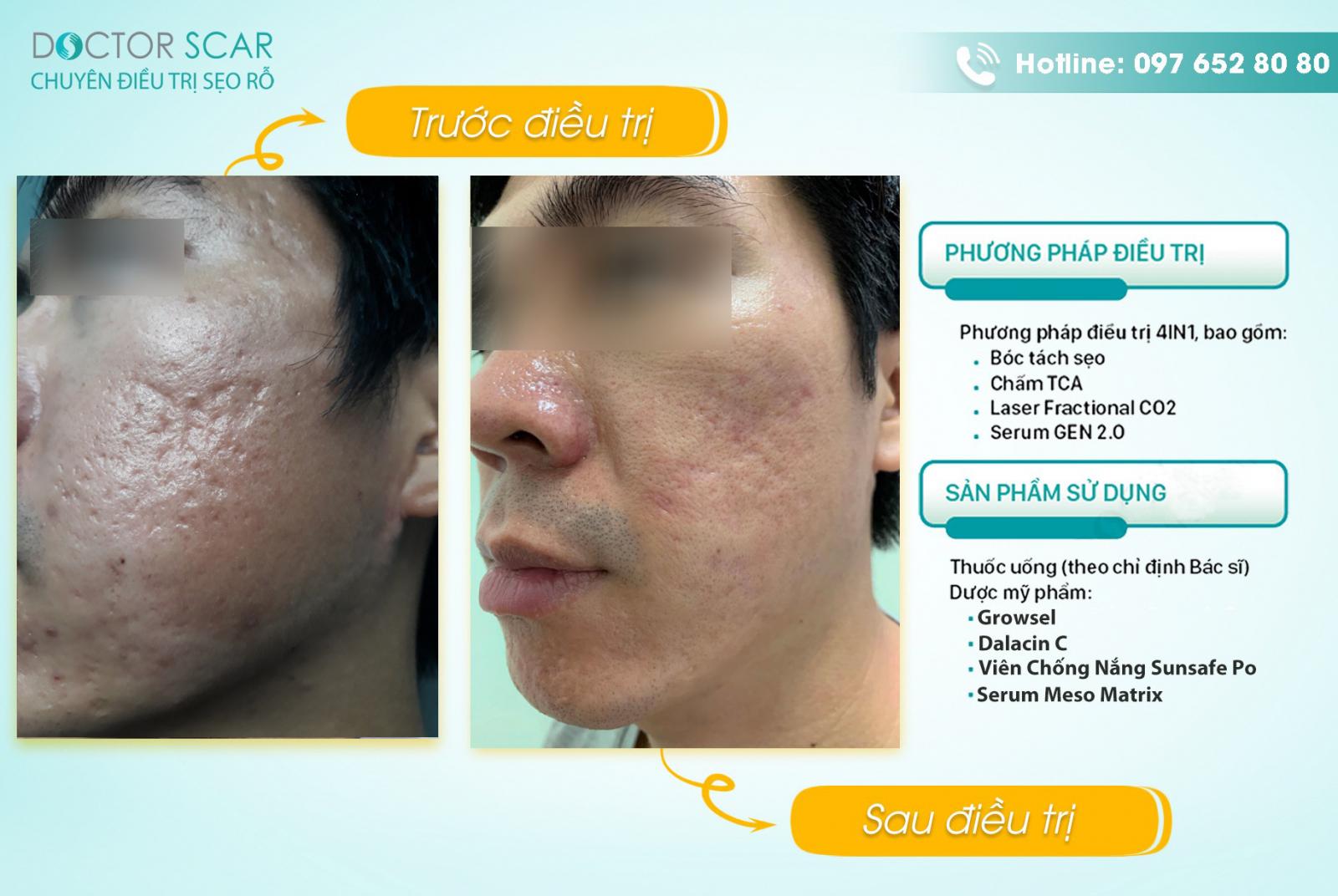 mot-so-hinh-anh-khach-hang-sau-dieu-tri-seo-tham-bang-laser-co2 Một số hình ảnh khách hàng sau điều trị sẹo thâm bằng Laser CO2