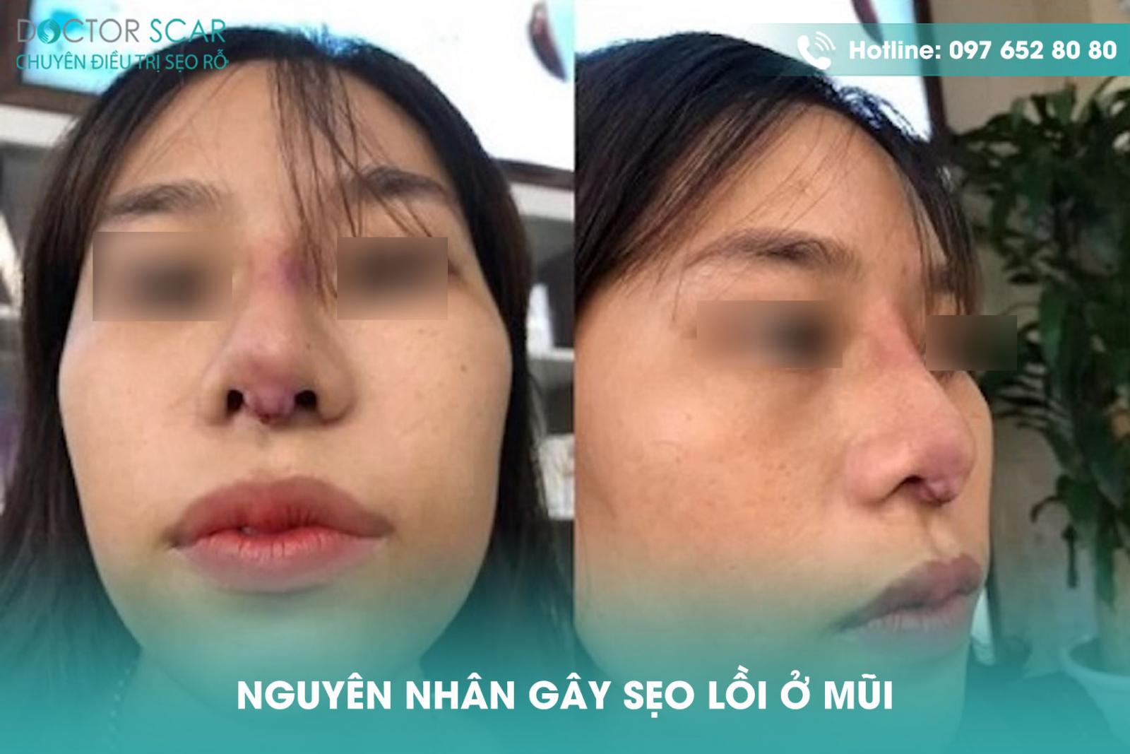 nguyen-nhan-gay-seo-loi-o-mui_ Nguyên nhân gây sẹo lồi ở mũi