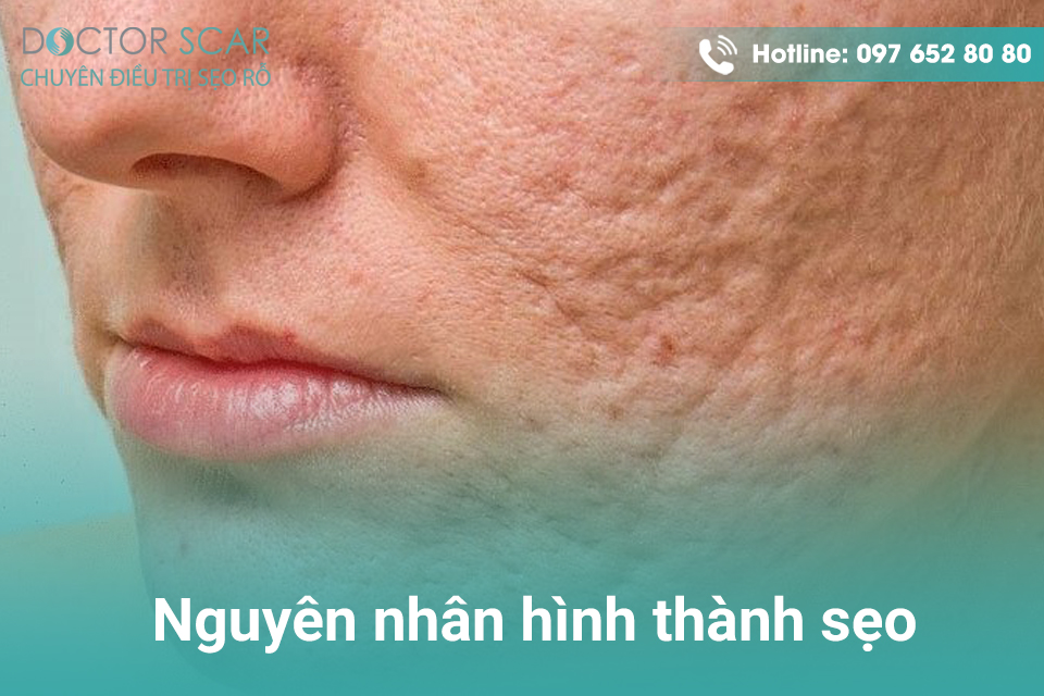 nguyen-nhan-hinh-thanh-seo Nguyên nhân hình thành sẹo.