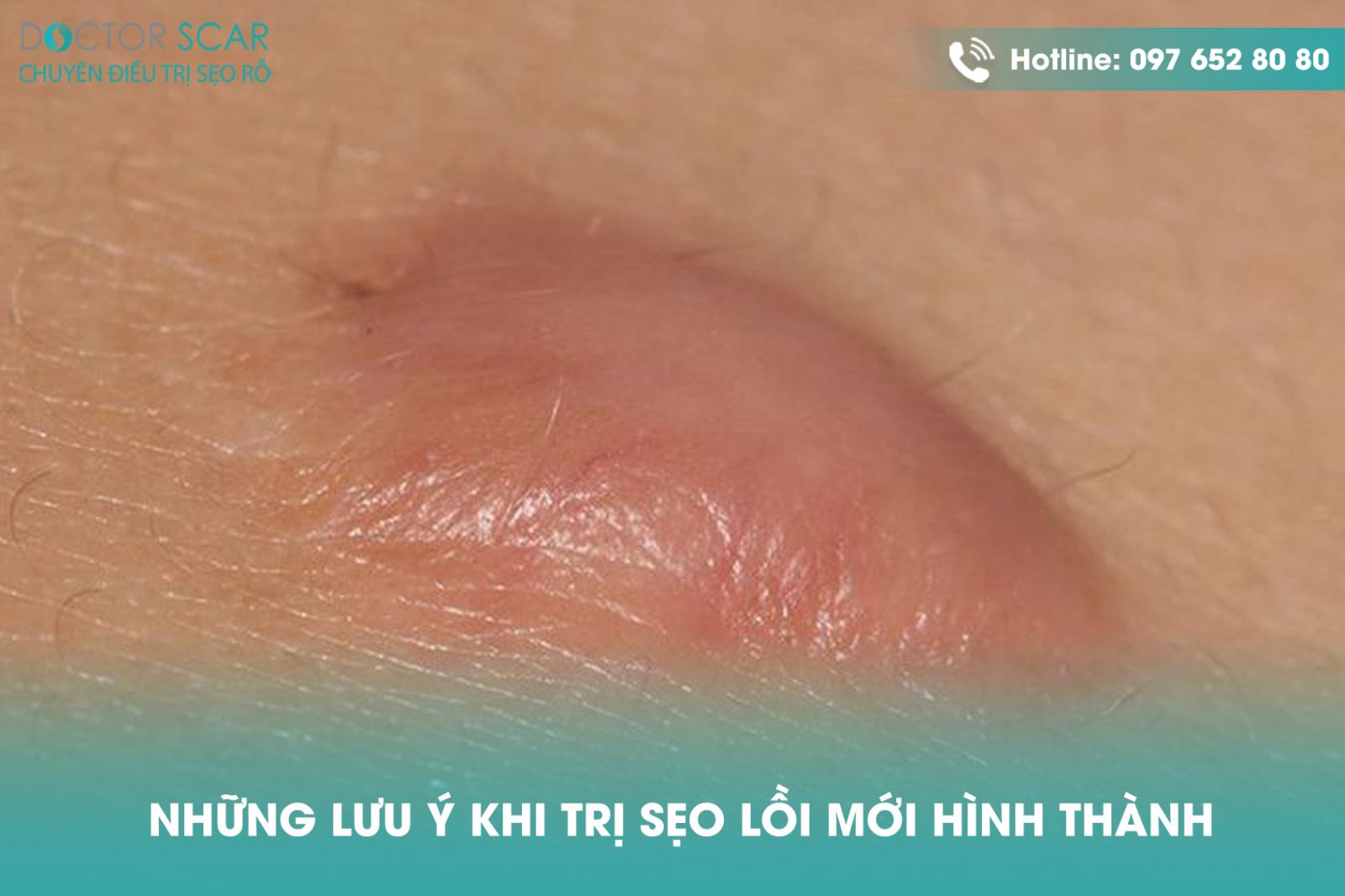 nhung-luu-y-khi-tri-seo-loi-moi-hinh-thanh Những lưu ý khi trị sẹo lồi mới hình thành