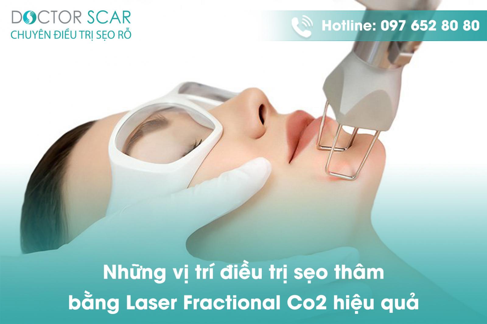 nhung-vi-tri-dieu-tri-seo-tham-bang-laser-fractional-co2-hieu-qua Những vị trí điều trị sẹo thâm bằng Laser Fractional CO2 hiệu quả