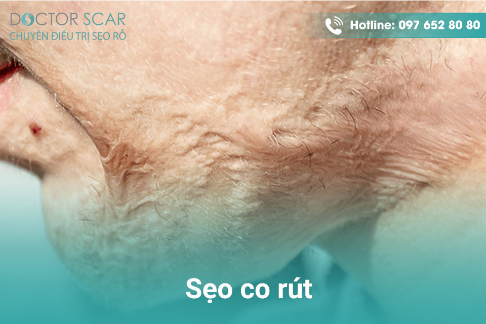 seo-co-rut Sẹo co rút.