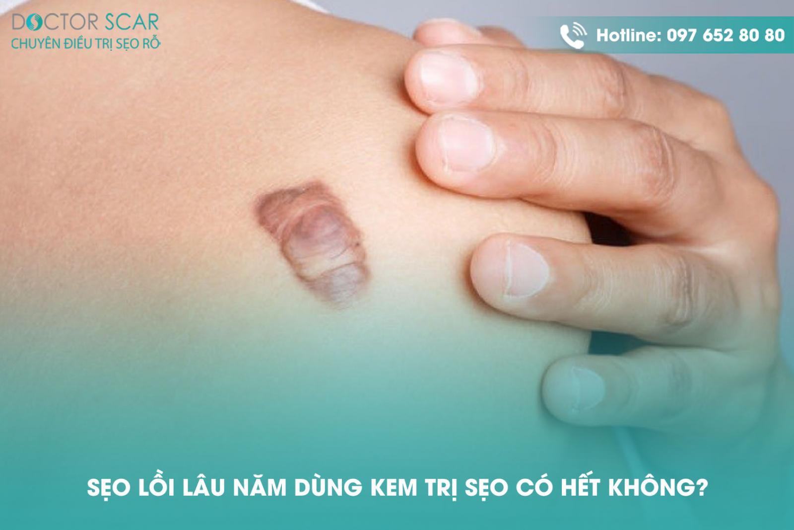 seo-loi-lau-nam-dung-kem-tri-seo-co-het-khong Sẹo lồi lâu năm dùng kem trị sẹo có hết không?