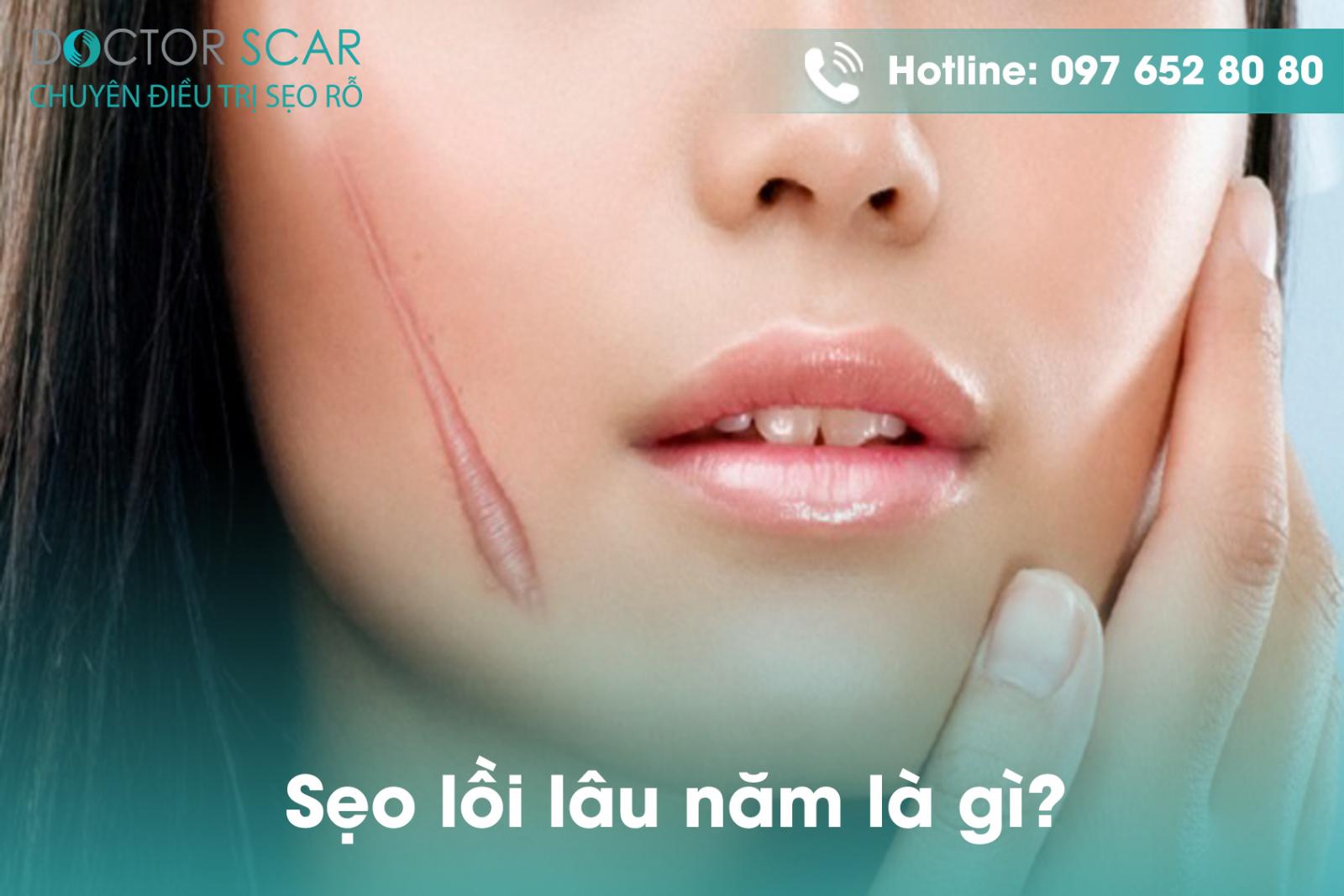 seo-loi-lau-nam-la-gi Sẹo lồi lâu năm là gì?