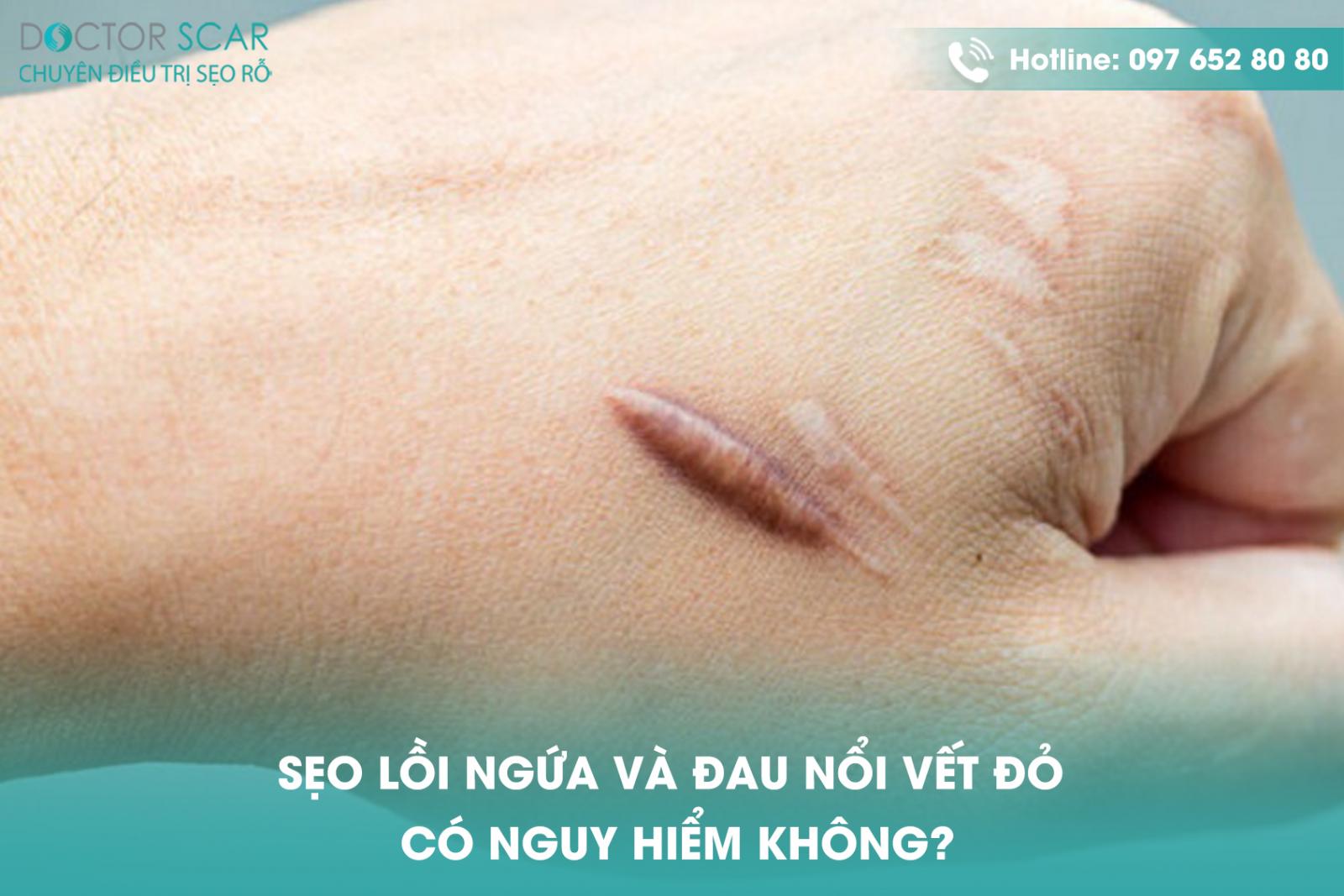 seo-loi-ngua-va-dau-noi-vet-do-co-nguy-hiem-khong Sẹo lồi ngứa và đau nổi vết đỏ có nguy hiểm không?