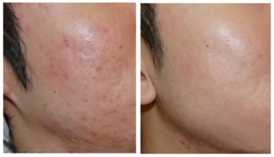 seo-lom-khong-chua-tri-het-khong2 lan-kim-dieu-tri-seo-ro