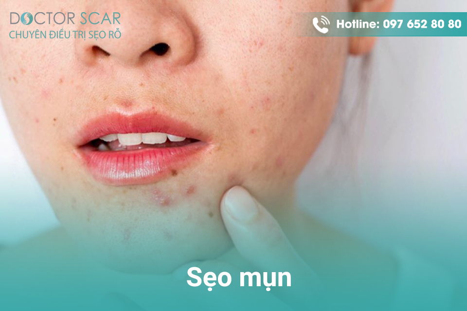 seo-mun Sẹo mụn.