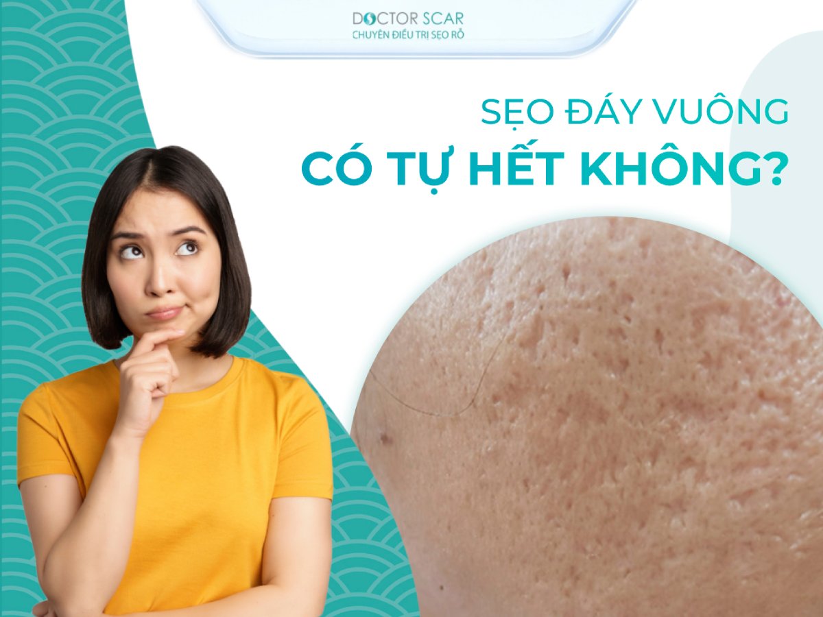 seo-ro-day-vuong-co-tu-het-khong Sẹo rỗ đáy vuông có tự khỏi không