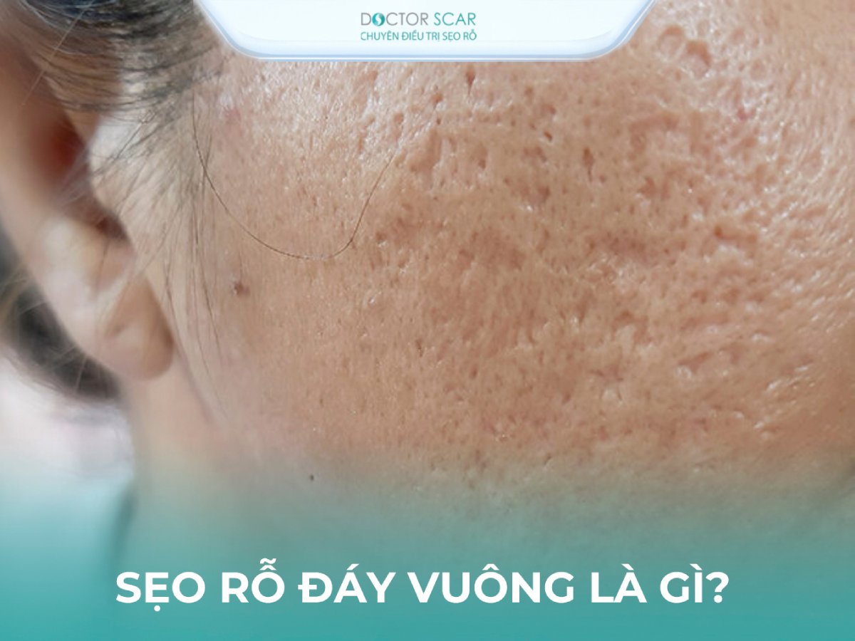 seo-ro-day-vuong-dau-hieu-nhan-biet Sẹo rỗ đáy vuông là gì? cách nhận biết