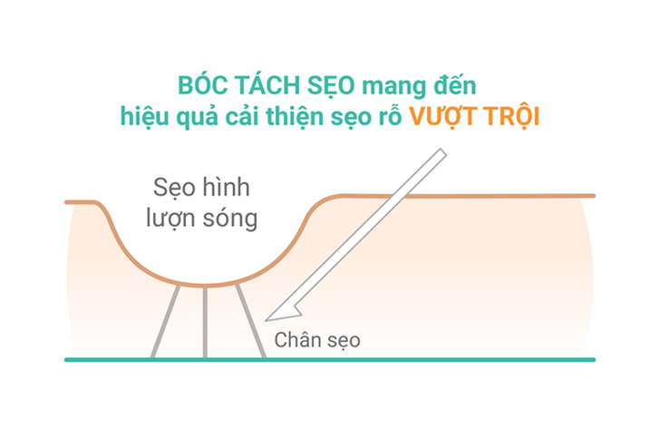 seo-ro-lau-nam-3 Bóc tách sẹo mang lại hiệu quả cải thiện vượt trội trong điều trị sẹo rỗ lâu năm