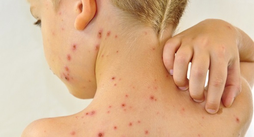 seo-ro-lau-nam-co-dieu-tri-duoc-khong-0 Sẹo thủy đậu nếu không điều trị kịp thời sẽ dẫn đến sẹo rỗ lâu năm và khó điều trị