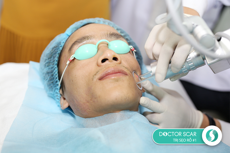 seo-ro-lau-nam-co-dieu-tri-duoc-khong-1 sẹo rỗ lâu năm có trị được không