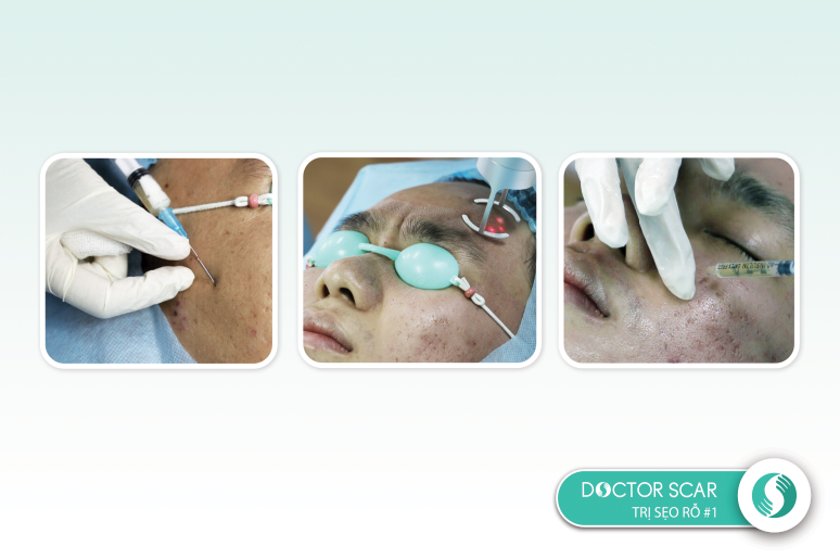 seo-ro-lau-nam-co-dieu-tri-duoc-khong-2 4 yếu tố quyết định hiệu quả điều trị sẹo rỗ/sẹo lõm lâu năm thành công