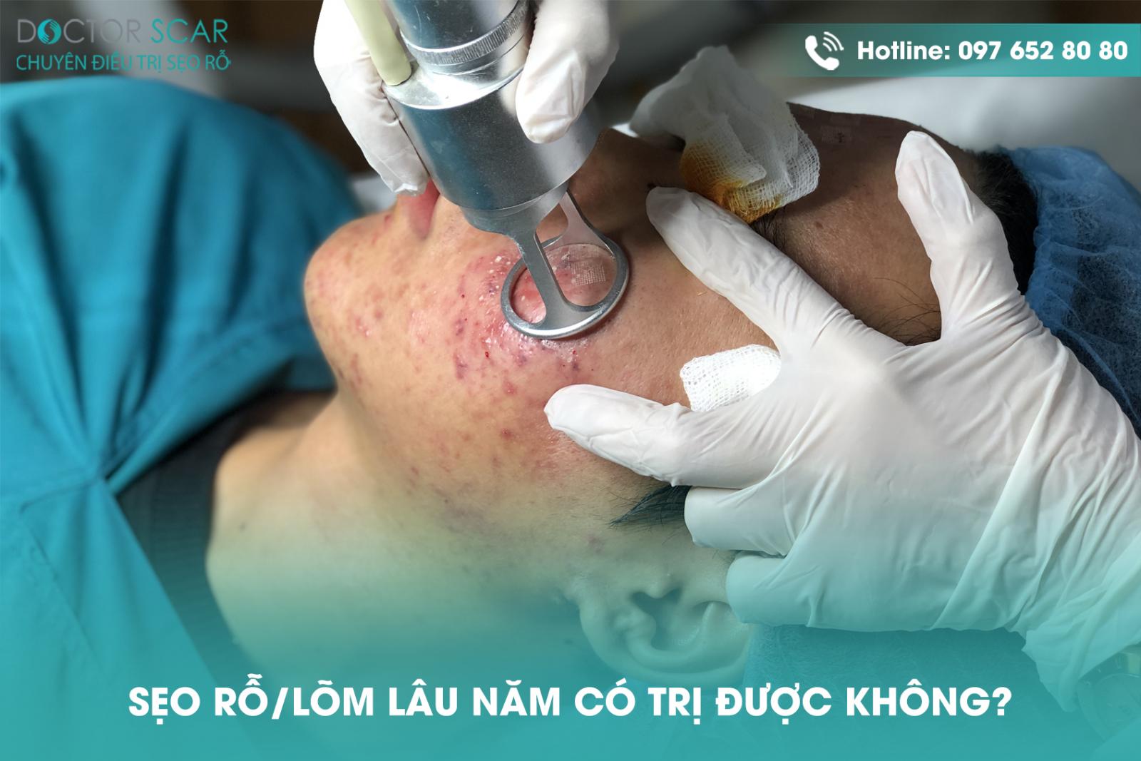 seo-ro-seo-lom-lau-nam-co-tri-duoc-khong Sẹo rỗ, sẹo lõm lâu năm có trị được không?