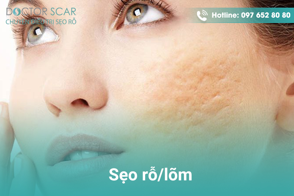 seo-ro-seo-lom Cách điều trị sẹo rỗ, sẹo lõm hiệu quả.