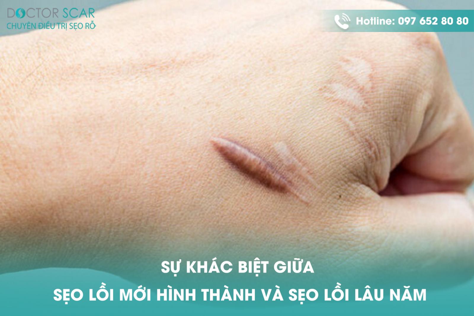 su-khac-biet-giua-seo-loi-moi-hinh-thanh-va-seo-loi-lau-nam Sự khác biệt giữa sẹo lồi mới hình thành và sẹo lồi lâu năm