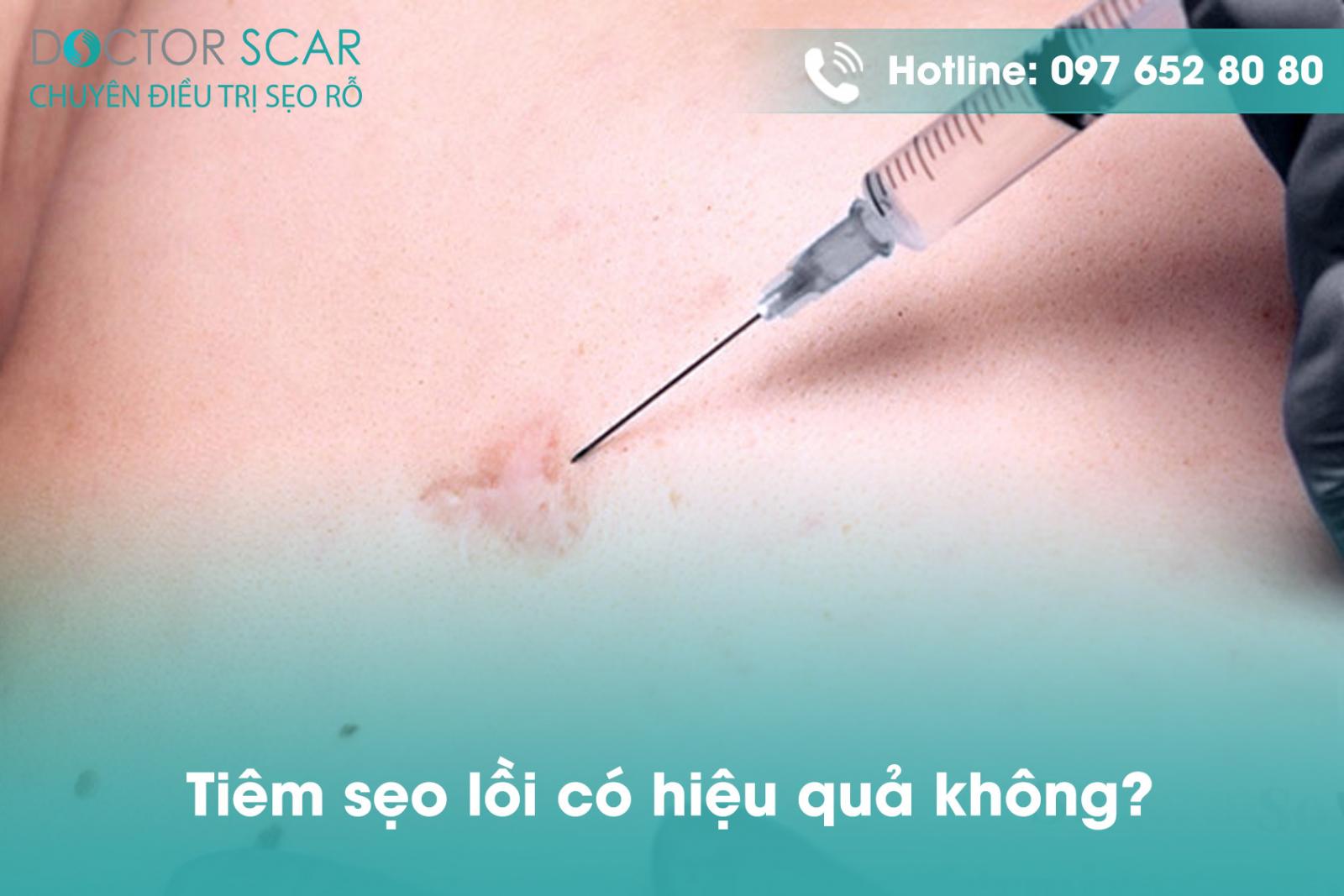 tiem-seo-loi-co-hieu-qua-khong1 Tiêm sẹo lồi có hiệu quả không?