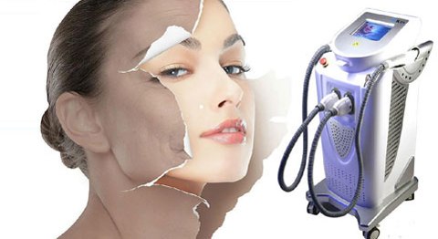 tre-hoa-da-mat-bang-laser-1 tre-hoa-da-bang-laser