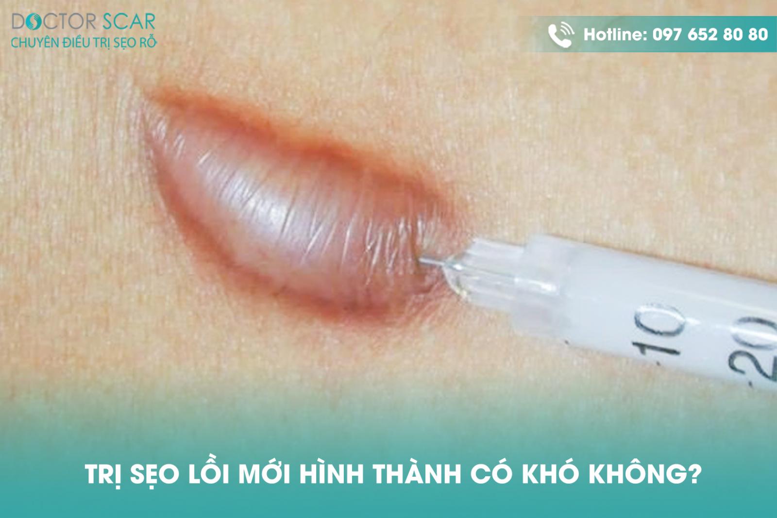 tri-seo-loi-moi-hinh-thanh-co-kho-khong Trị sẹo lồi mới hình thành có khó không?