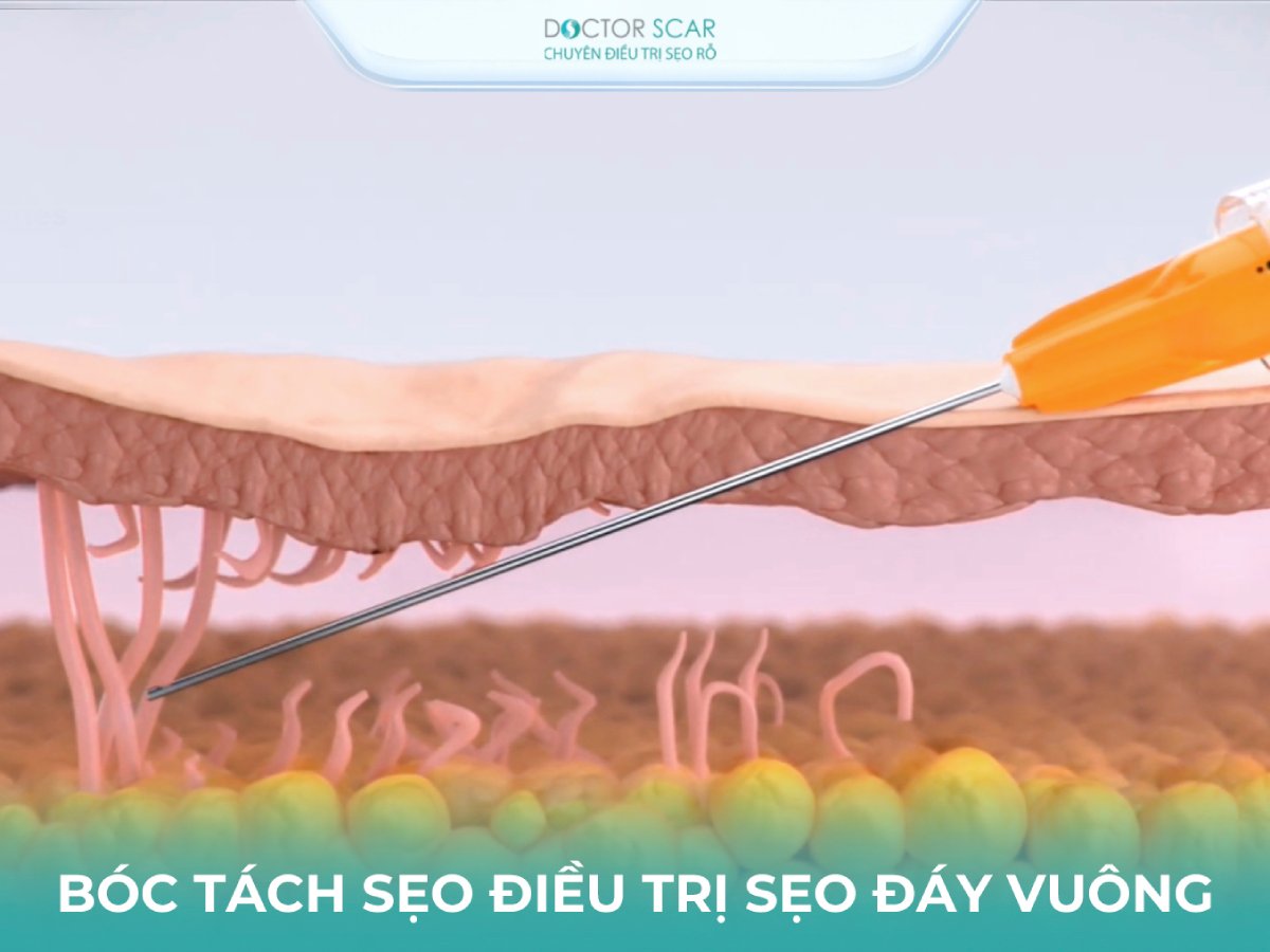 tri-seo-ro-day-vuong-bang-boc-tach-seo Trị sẹo rỗ đáy vuông bằng phương pháp bóc tách sẹo