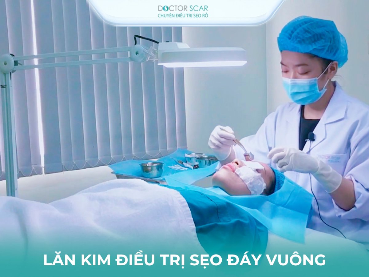 tri-seo-ro-day-vuong-bang-lan-kim Trị sẹo rỗ đáy vuông bằng lăn kim