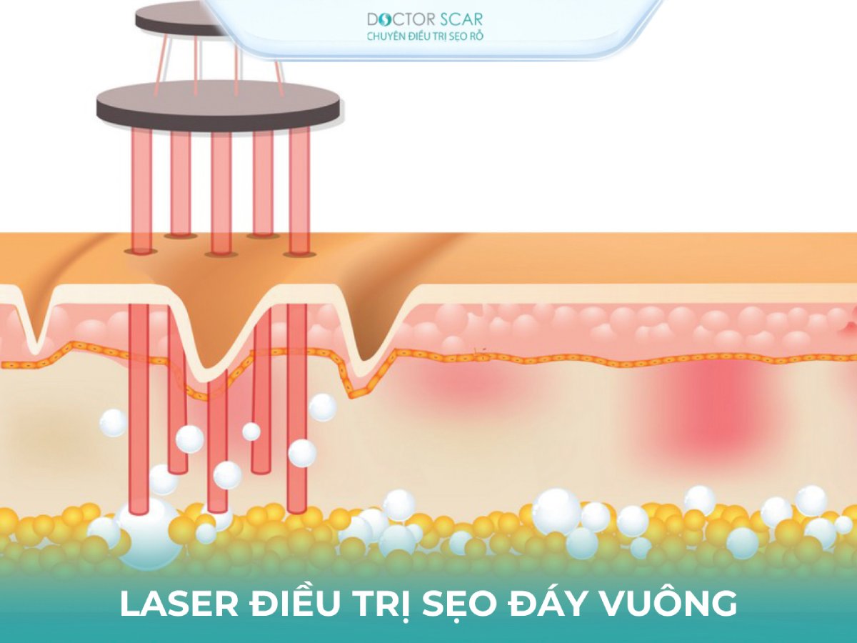 tri-seo-ro-day-vuong-bang-laser-co2 Trị sẹo rỗ đáy vuông bằng laser co2