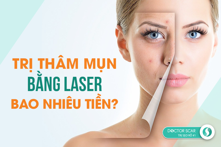 tri-tham-mun-bang-laser-bao-nhieu-tien Trị thâm mụn bằng laser bao nhiêu tiền