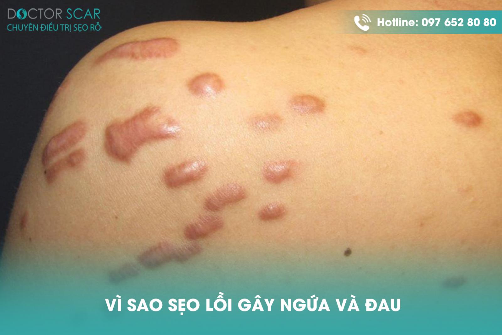 vi-sao-seo-loi-gay-ngua-va-dau Vì sao sẹo lồi gây ngứa và đau?