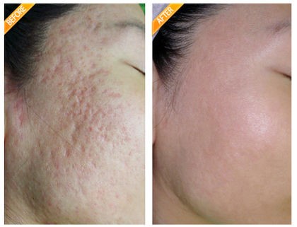 xtruoc-sau-dieu-tri-seo-loi-seo-lom may-laser-fractional-co2