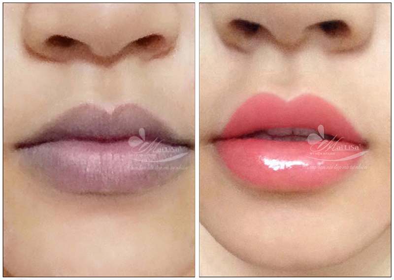 môi trước và sau khi phun môi phủ bóng collagen môi trước và sau khi phun môi phủ bóng collagen