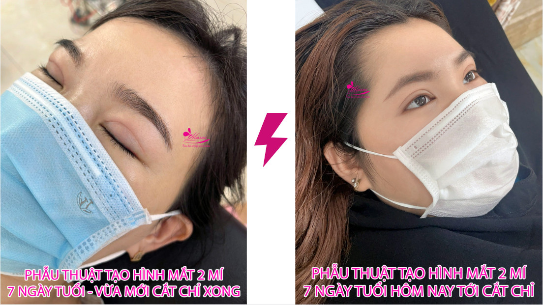 Phẫu thuật tạo hình mắt 2 mí Perfect Line Phẫu thuật tạo hình mắt 2 mí Perfect Line