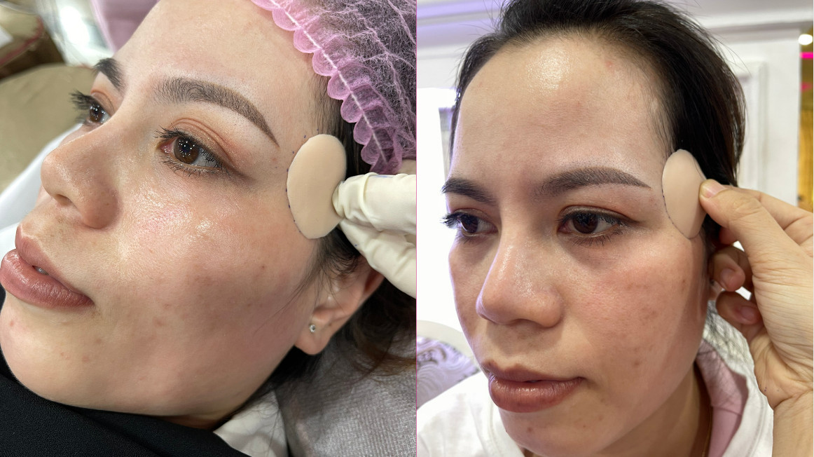 Làm đầy thái dương hàn quốc Làm đầy thái dương hàn quốc