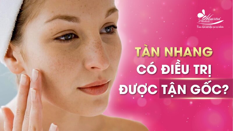 Tàn nhang bẩm sinh có chữa được không - 4 Cách chữa tàn nhang bẩm sinh 4 - 4 cách trị tàn nhang bẩm sinh Dieu tri tan goc tan nhang