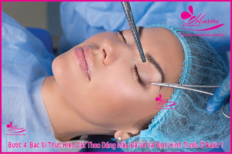 Phẫu thuật nâng cơ mí mắt là gì? Giá bao nhiêu HỢP LÝ 2023? Bác sĩ cắt theo dáng mẫu đã vẽ định hình