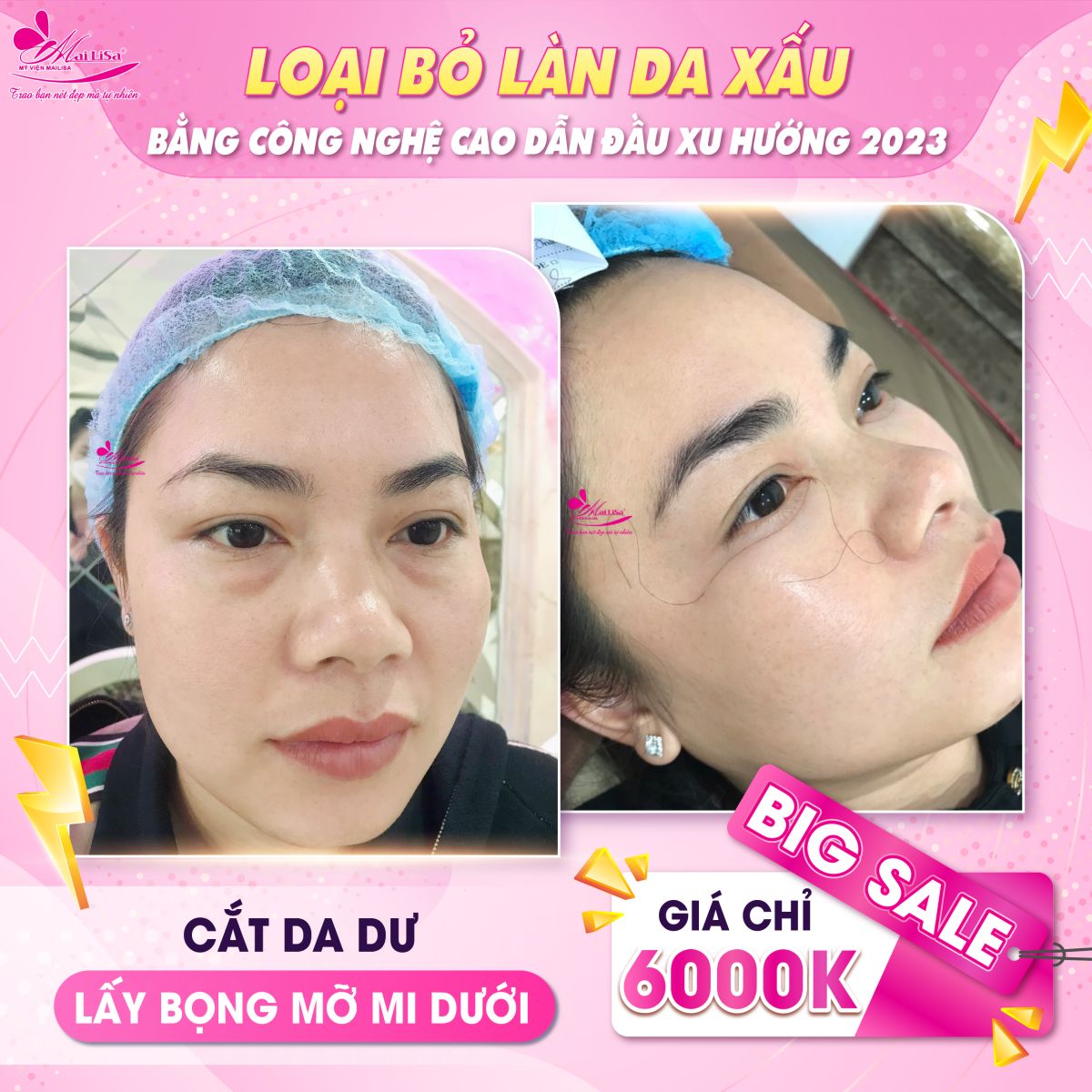 SĂN SALE KHỦNG - NHẬN QUÀ TO mừng ngày 8 tháng 3 tại Mailisa lấy bọng mỡ mí mắt