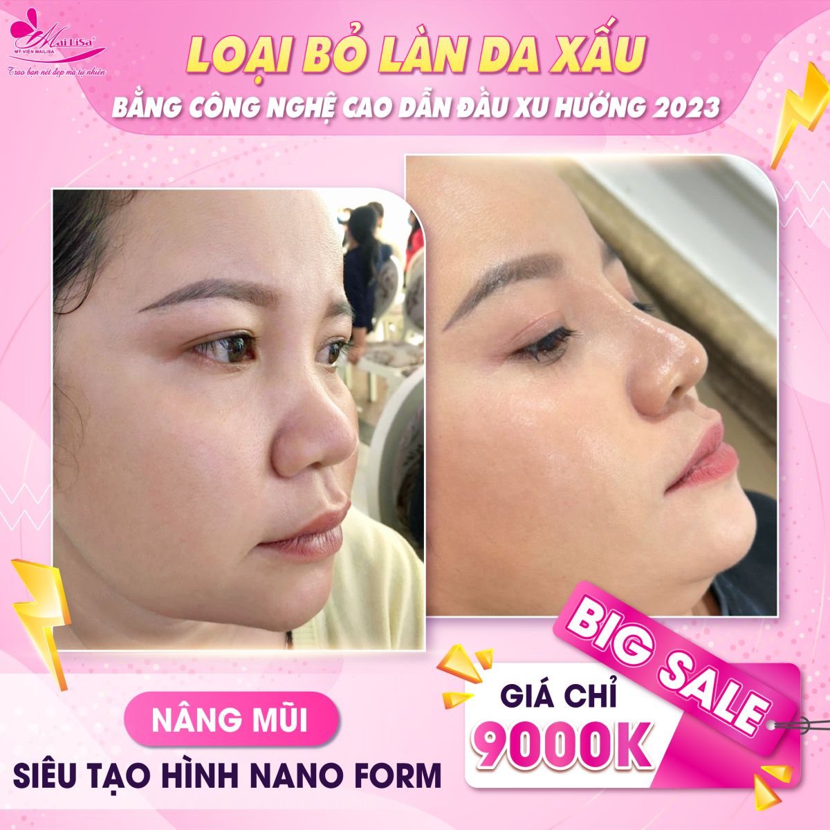 SĂN SALE KHỦNG - NHẬN QUÀ TO mừng ngày 8 tháng 3 tại Mailisa nâng mũi