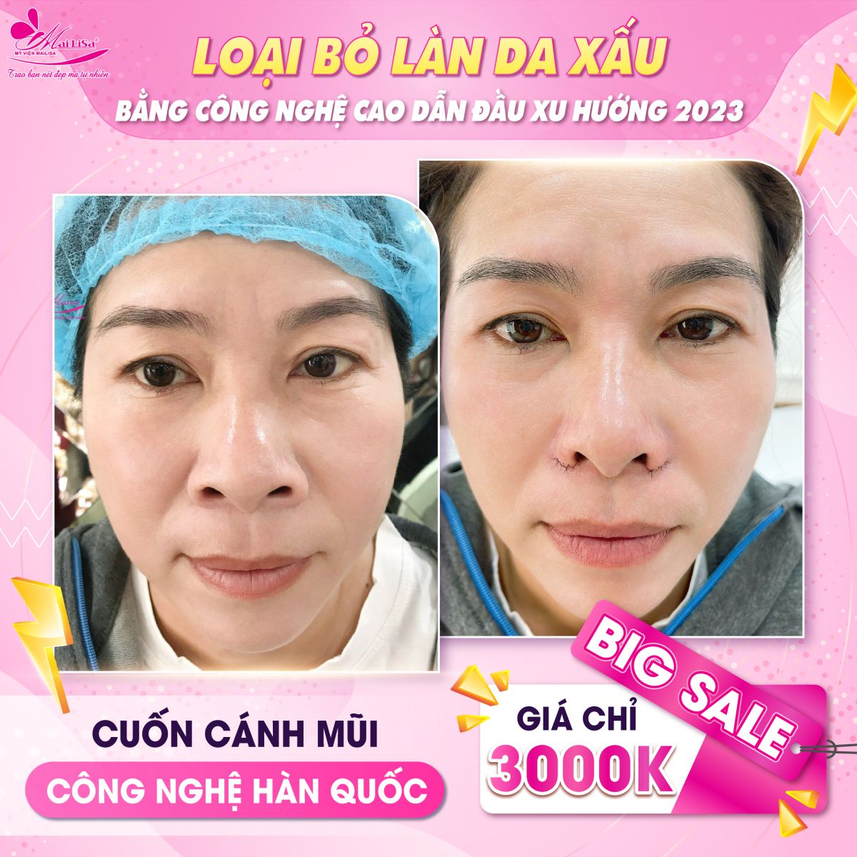 SĂN SALE KHỦNG - NHẬN QUÀ TO mừng ngày 8 tháng 3 tại Mailisa thu gọn cánh mũi