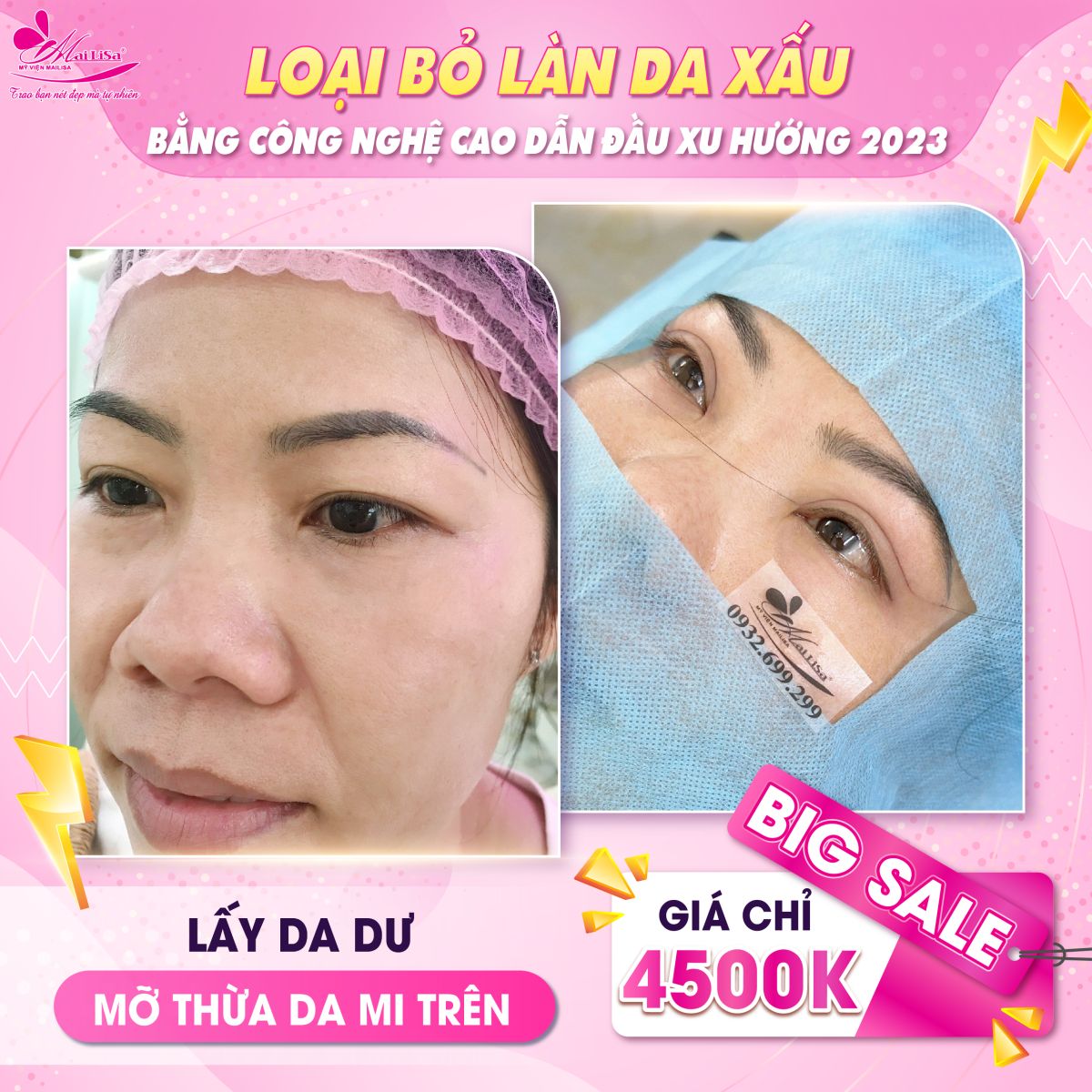SĂN SALE KHỦNG - NHẬN QUÀ TO mừng ngày 8 tháng 3 tại Mailisa da thừa mi trên